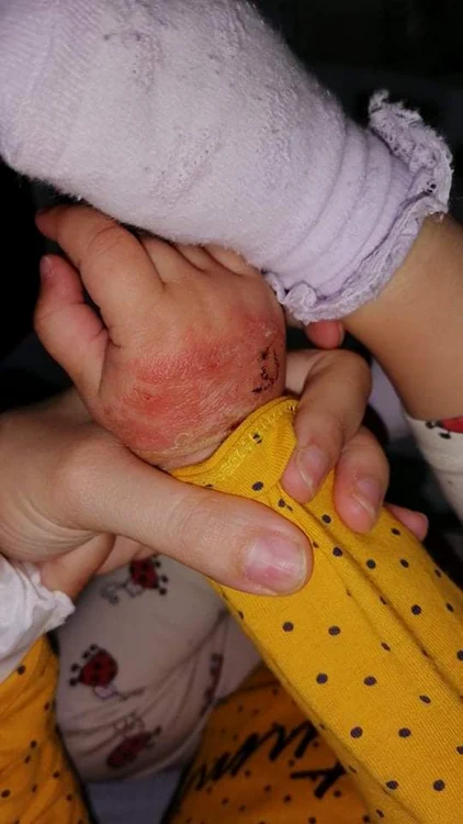 Fetiţa are o rană la una dintre mâini din cauza bandajului cu care era prinsă branula
