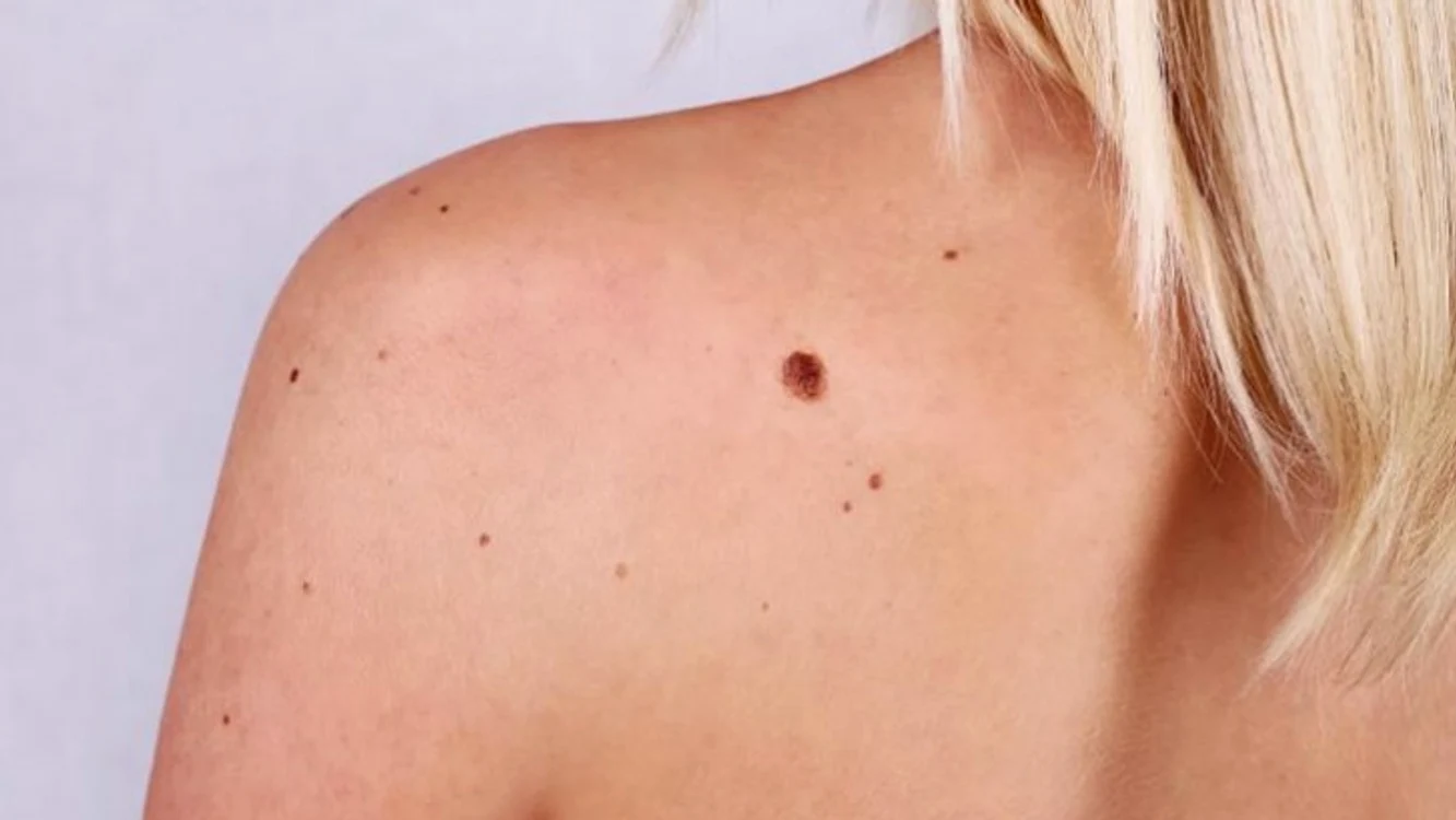 Leziunile tumorale pot să apară pe orice suprafață a pielii Foto: Arhivă