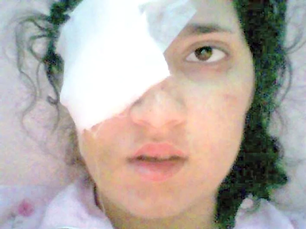 Daniela Borz  are acum un ochi  de sticlă, după  ce a suferit mai multe  intervenţii chirurgicale 