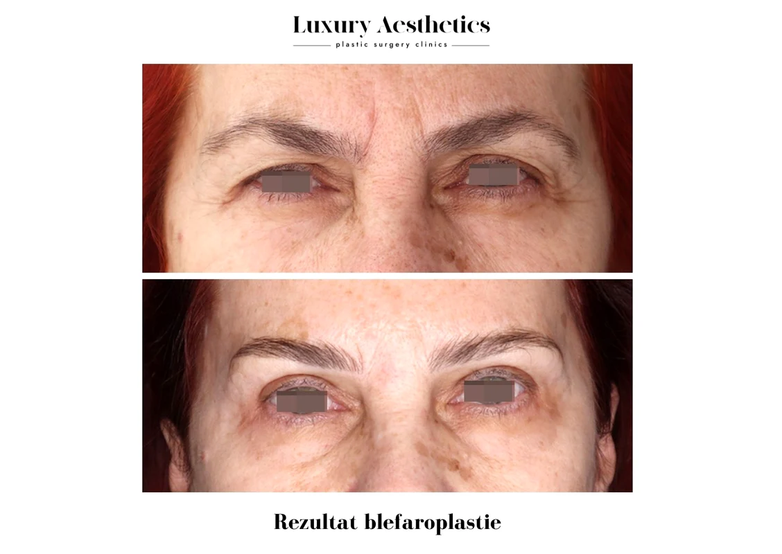 rezultat blefaroplastie iancu morad luxury aesthetics 2 jpg