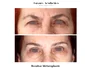 rezultat blefaroplastie iancu morad luxury aesthetics 2 jpg