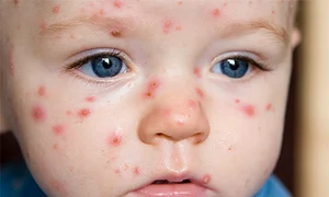 ce dieta trebuie sa aiba copilul bolnav de varicela jpeg