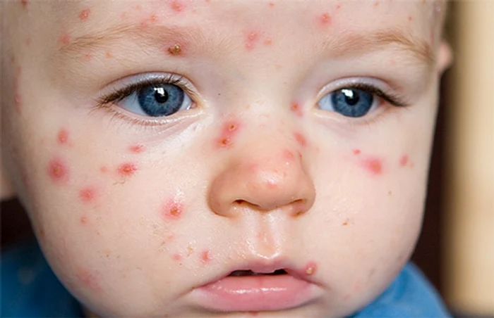 Ce dietă trebuie să aibă copilul bolnav de varicelă