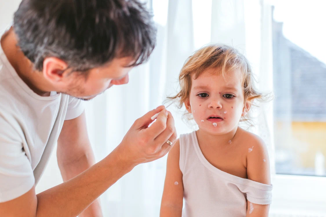 Varicela afectează în special copiii (Foto: Shutterstock)