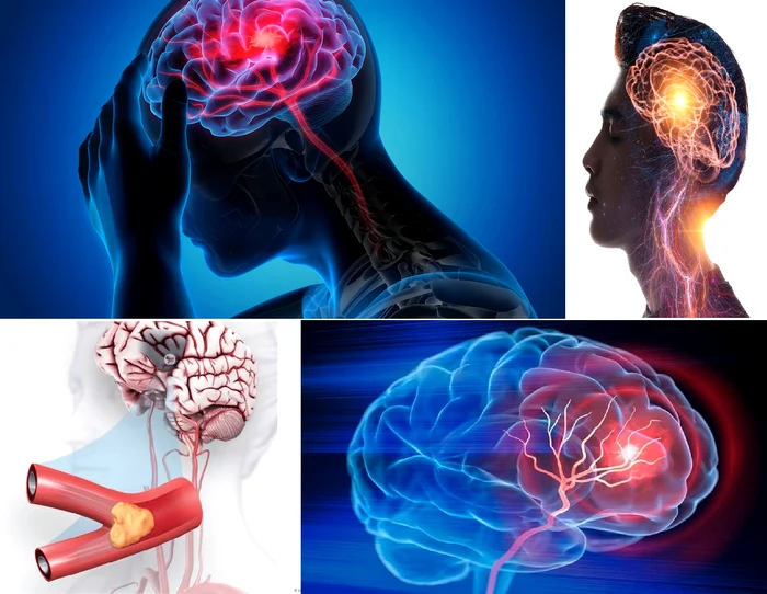 Atacul cerebral vascular reprezintă una dintre principalele cauze de deces în România Colaj  DMS
