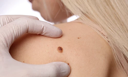 1 dermatoscopie jpg jpeg