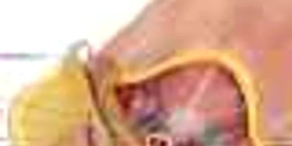 transplant penis