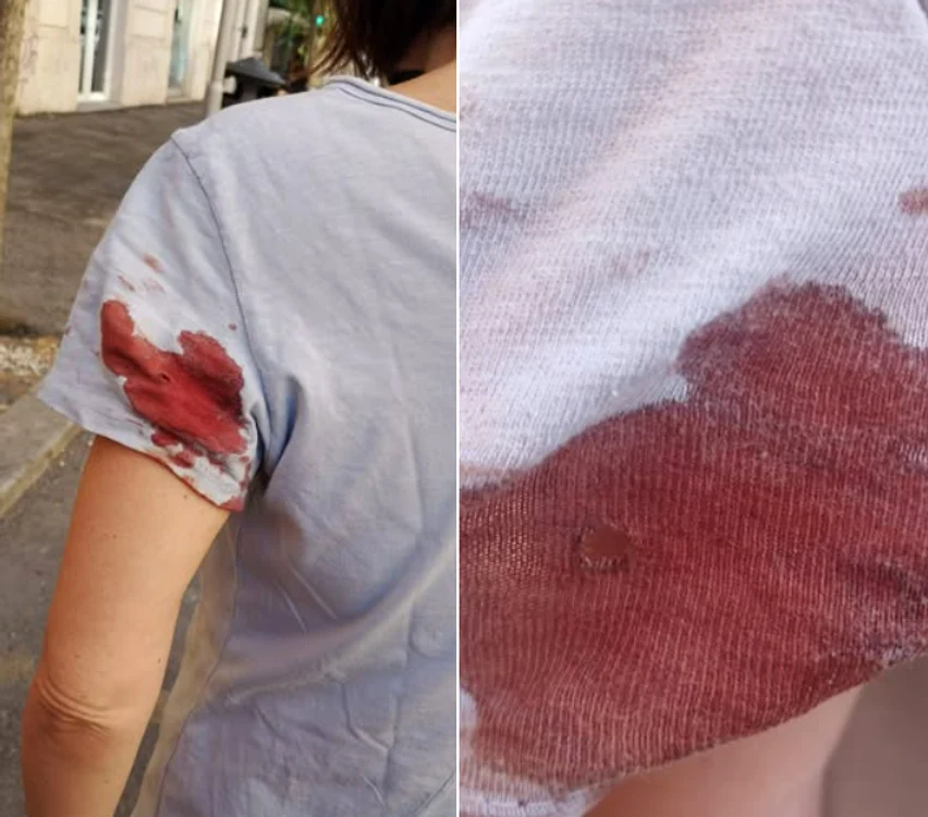 Jurnalista a fost împușcată în braț