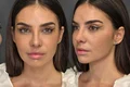 Mellina și-a operat nasul! Artista e super fericită la zece zile de la intervenția estetică de rinoplastie