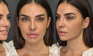 Mellina și-a operat nasul! Artista e super fericită la zece zile de la intervenția estetică de rinoplastie