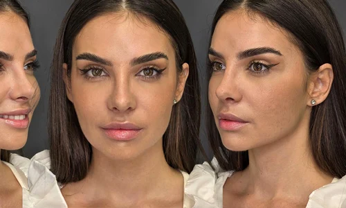 Mellina și-a operat nasul! Artista e super fericită la zece zile de la intervenția estetică de rinoplastie