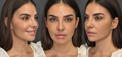 Mellina și-a operat nasul! Artista e super fericită la zece zile de la intervenția estetică de rinoplastie