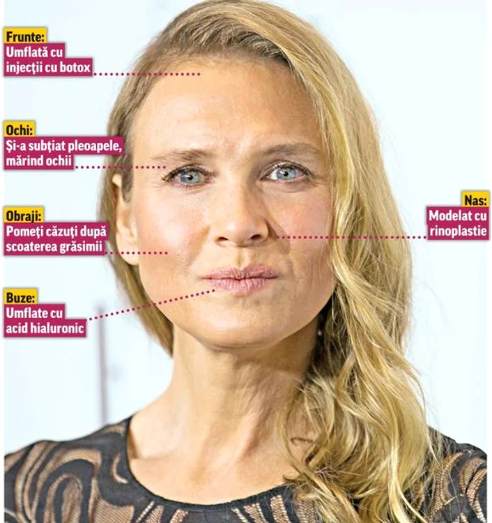 Renee are chipul distrus de operaţii 