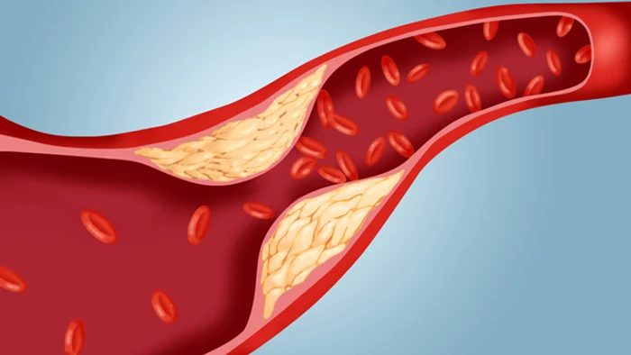 
    Colesterolul rău e dăunător pentru sistemul cardiovascularwww.clicksanatate.ro  