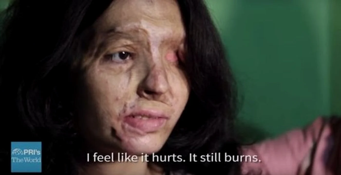 
    Reshma Quereshi a fost atacată cu acid sulfuric Foto: upworthy.com  
