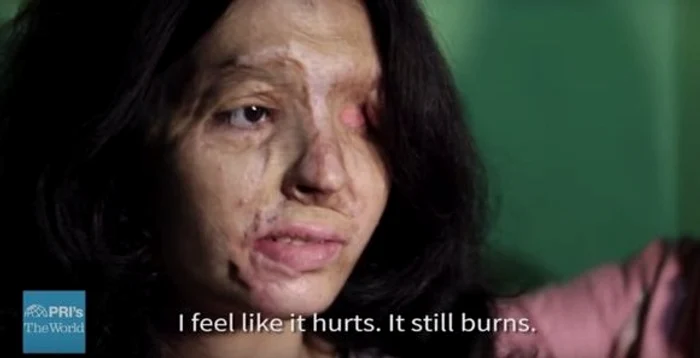 Reshma Quereshi a fost atacată cu acid sulfuric Foto: upworthy.com