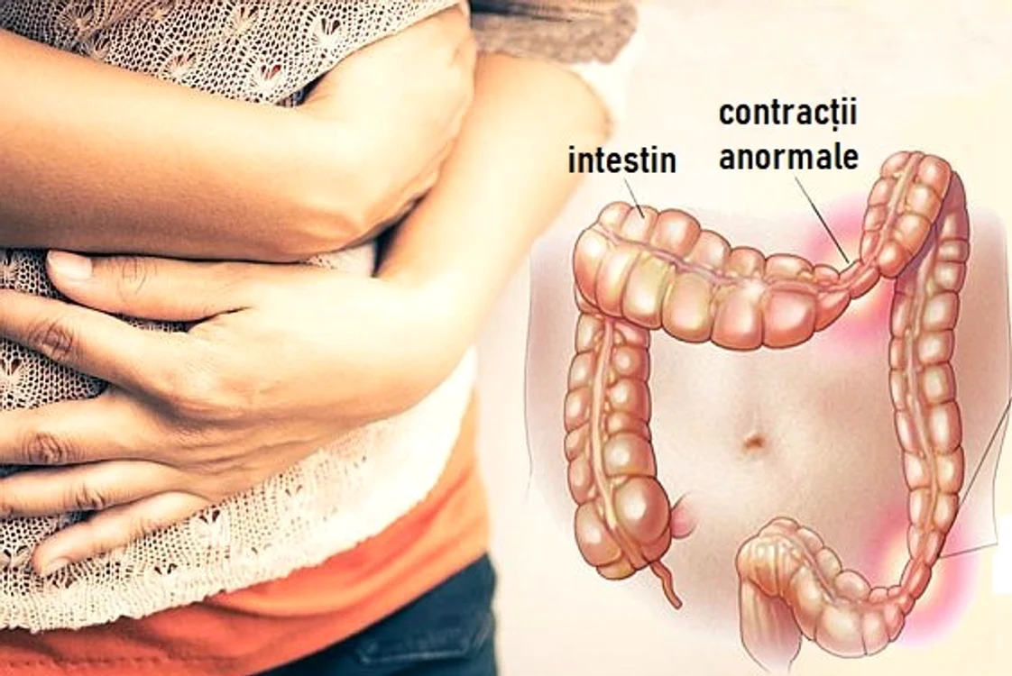 Simptome colon iritabil jpeg