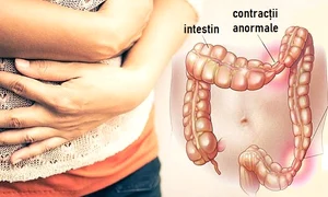Simptome colon iritabil jpeg