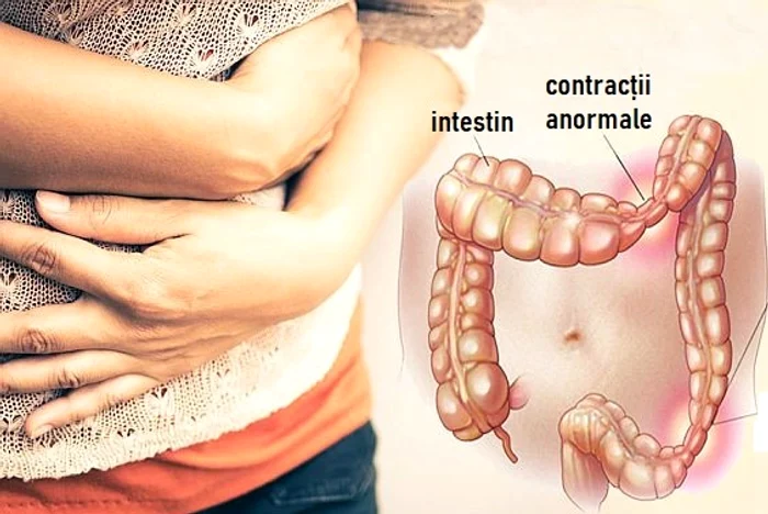 Simptome colon iritabil jpeg