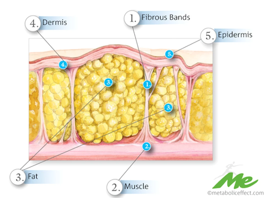 1. Benzi fibroase; 2. Muşchi; 3. Grăsime; 4. Dermă; 5. Epidermă