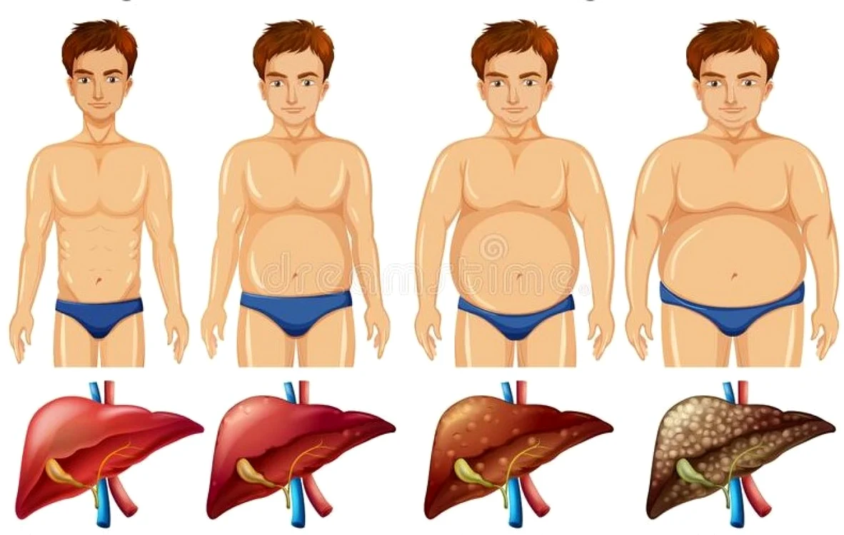 Un tratament inovativ în cancerul hepatic e disponibil şi în România, foto arhivă