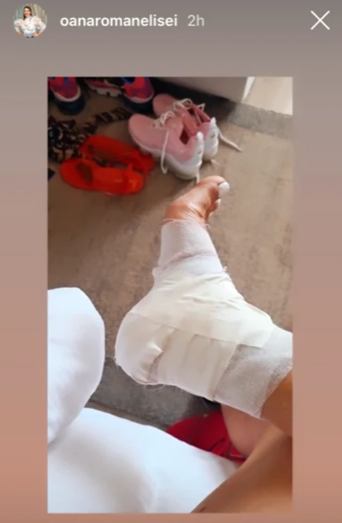 Așa arată piciorul Oanei după intervenția medicilor