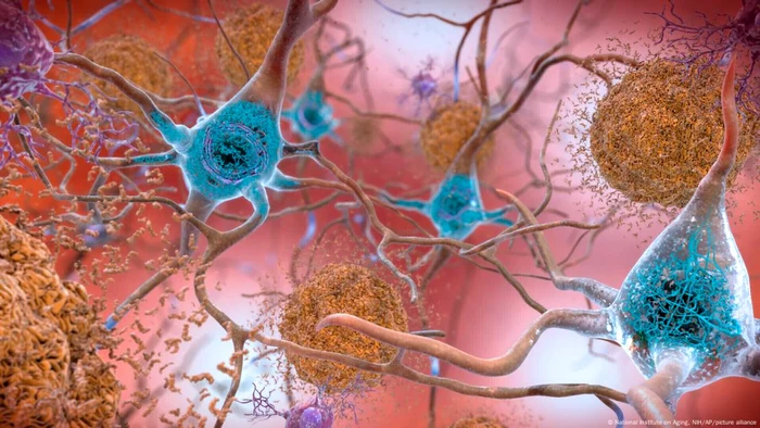 În cazul pacienților afectați de Alzheimer, celulele creierului sunt inflamate