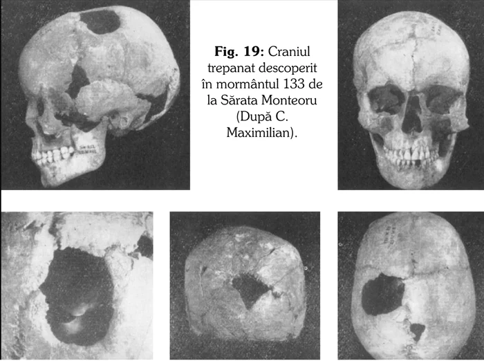 Cranii cu urme de trepanații. Sursa: Medicina în Dacia (Ed. Dacica, 2007)