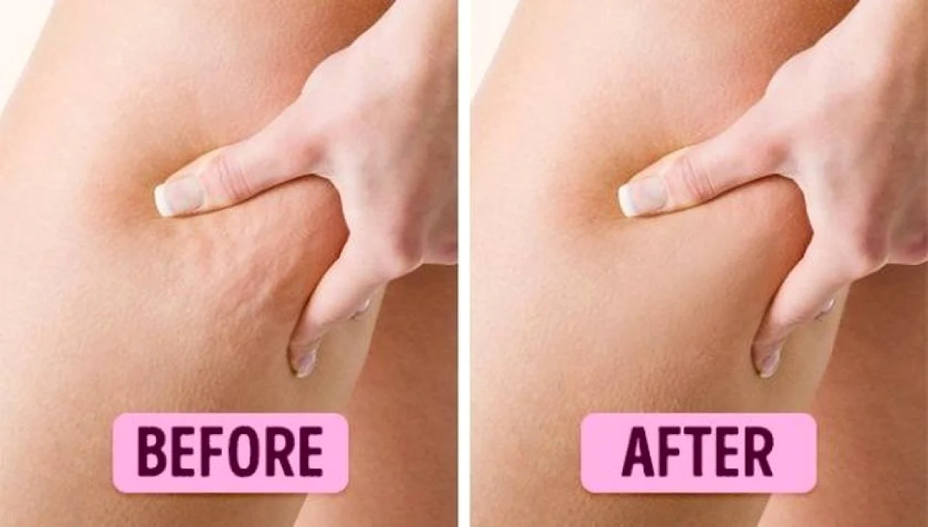 Ia-ţi adio de la celulită! Ce conţine crema care îţi va face picioarele frumoase şi catifelate