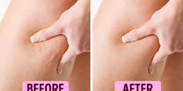 Ia-ţi adio de la celulită! Ce conţine crema care îţi va face picioarele frumoase şi catifelate