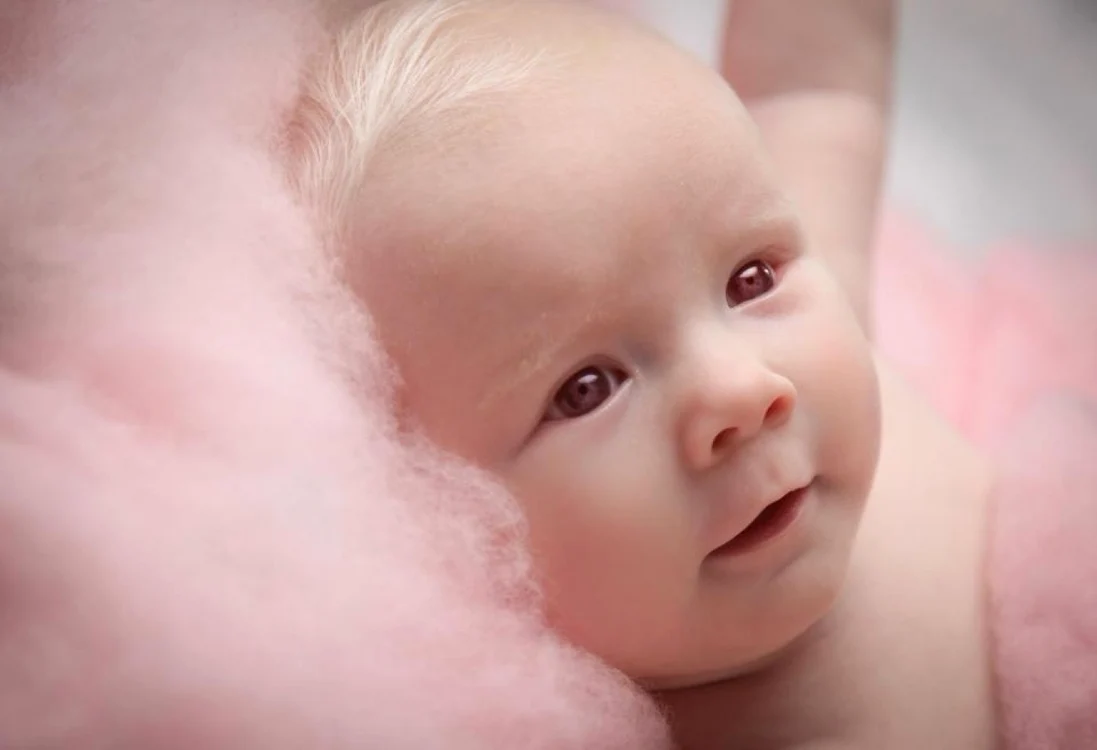 Fetiţa care suferă de albinism FOTO The Sun