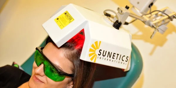 laser alopecie