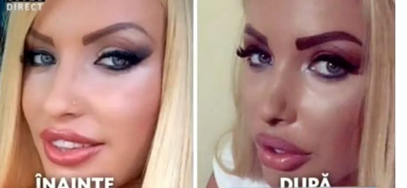 Înainte și după rinoplastie