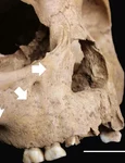 Leziuni ale scheletului în concordanță cu treponematoză congenitală la un copil de 5 ani din Man Bac, Vietnam (© Vlok et al. 2026, CC BY-NC 4.0)