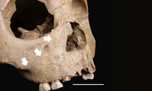 Leziuni ale scheletului în concordanță cu treponematoză congenitală la un copil de 5 ani din Man Bac, Vietnam (© Vlok et al. 2026, CC BY-NC 4.0)