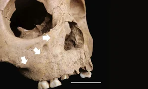 Leziuni ale scheletului în concordanță cu treponematoză congenitală la un copil de 5 ani din Man Bac, Vietnam (© Vlok et al. 2026, CC BY-NC 4.0)