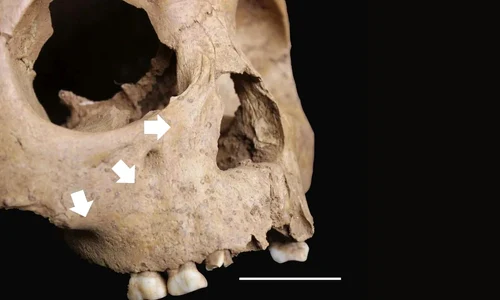 Leziuni ale scheletului în concordanță cu treponematoză congenitală la un copil de 5 ani din Man Bac, Vietnam (© Vlok et al. 2026, CC BY-NC 4.0)