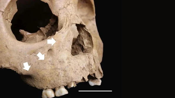 Leziuni ale scheletului în concordanță cu treponematoză congenitală la un copil de 5 ani din Man Bac, Vietnam (© Vlok et al. 2026, CC BY-NC 4.0)