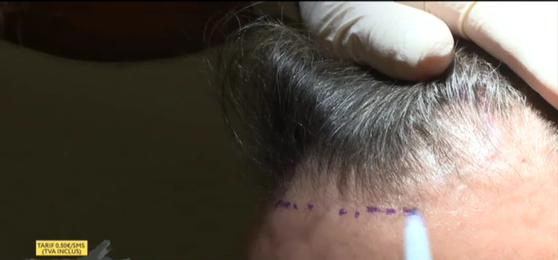 Dan Helciug Vorbeste Lumea implant de par png