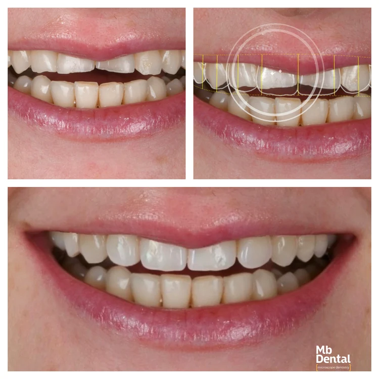 colaj caz MB Dental jpg