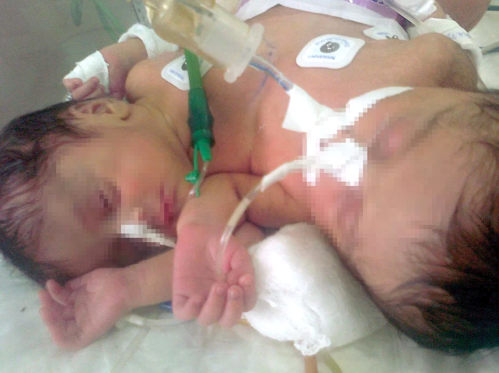 
    Siamezele sunt unite în zona toracelui şi abdomenului şi cântăresc împreună 3 kg  