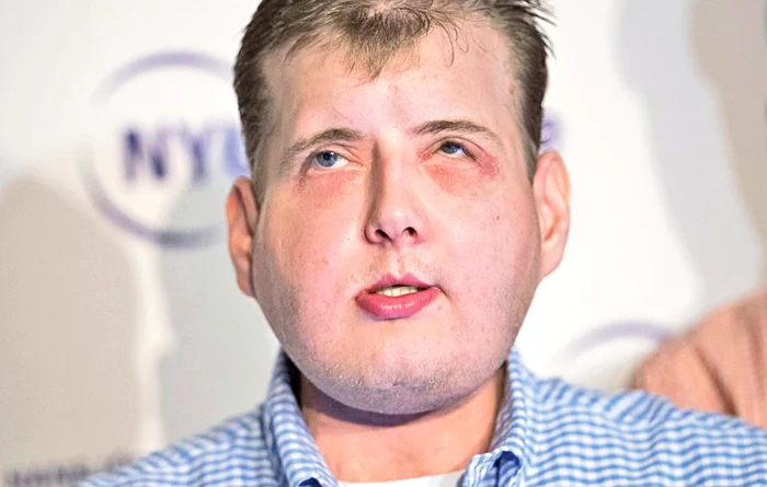 Miracol! Patrick Hardison a devenit un monstru în 2001, dar medicii l-au salvat