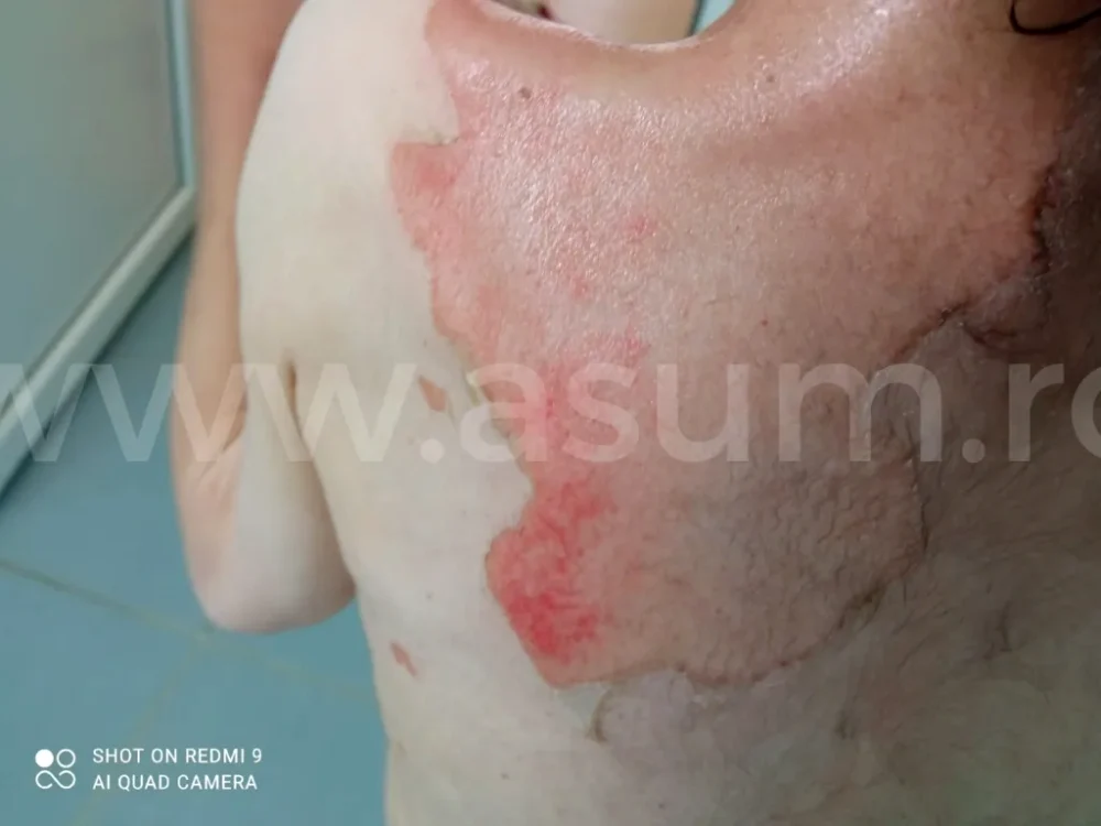 Tânără arsă într-un centru al Protecției Copilului Brașov FOTO ASUM Brașov