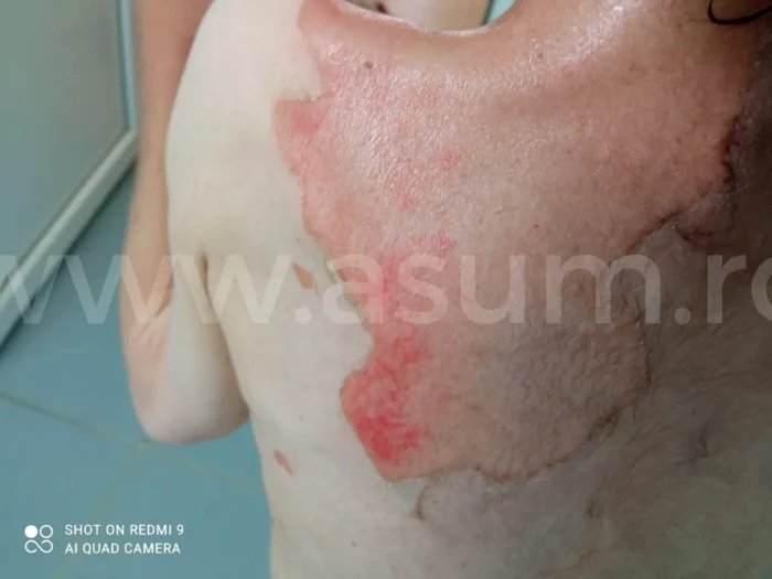 Tânără arsă într-un centru al Protecției Copilului Brașov FOTO ASUM Brașov