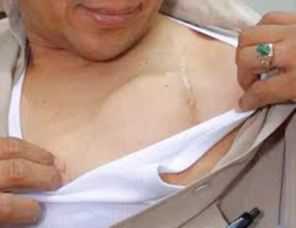 Defibrilatorul se implantează în apropierea claviculei. Bateria unui astfel de aparat ţine între patru şi şase ani