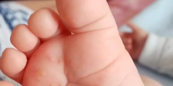 calarasi boala care face ravagii vara FOTO Facebv/Spitalul virtual pentru copii