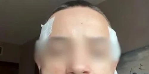 Francez sinucidere transplant de barbă nereușit png