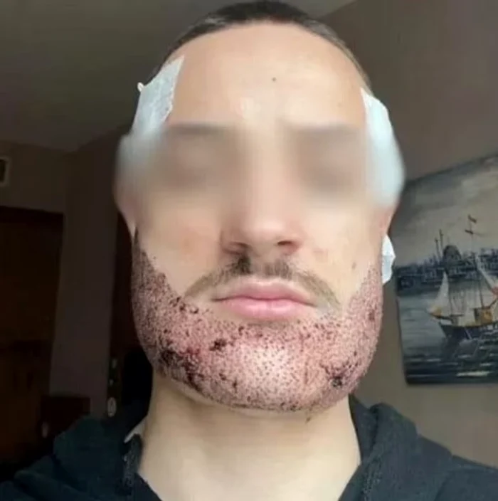 Mathieu Vigier Latour după implantul de păr