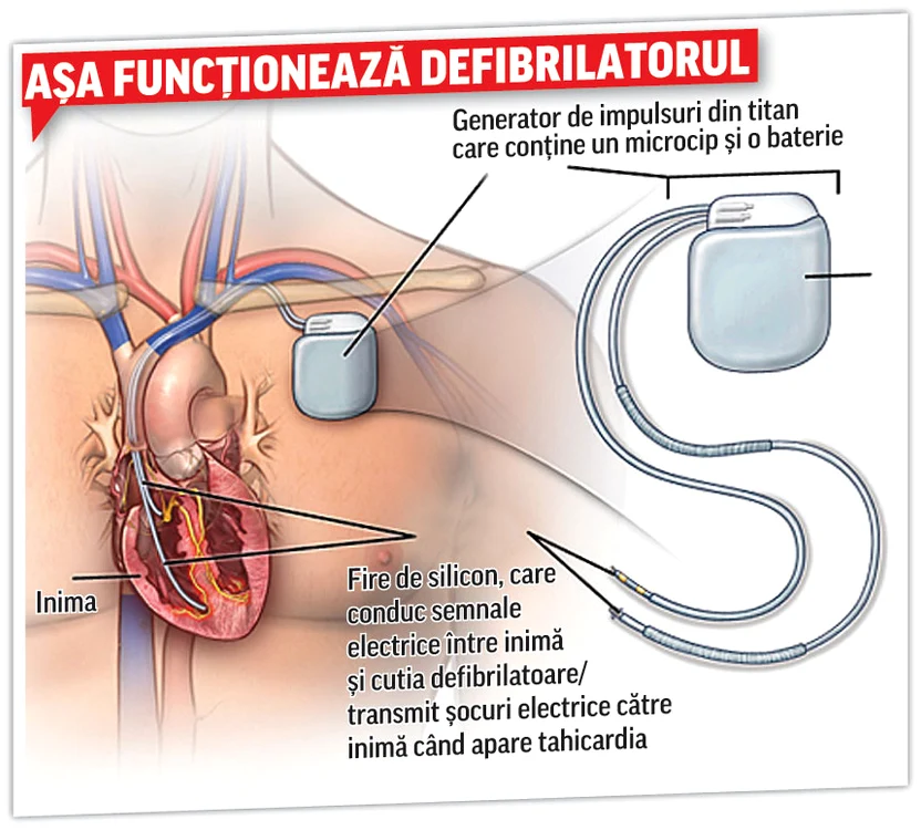 
    Defibrilatorul se implantează în apropierea claviculei. Bateria unui astfel de aparat ţine între patru şi şase ani  