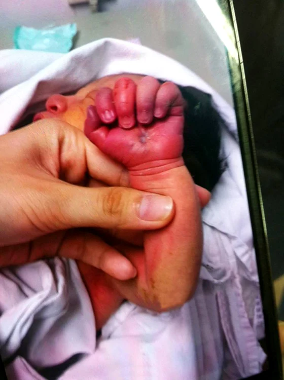 Copilul avea muşcături pe mâna stângă